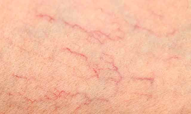 Сосудистые звездочки на ногах - причины, симптомы и лечение