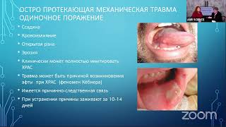 Стоматит – самая важная информация об отдельных формах заболевания