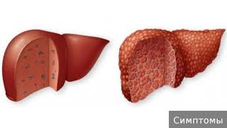 Токсическое поражение печени