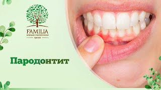 Пародонтит - Симптомы и причины