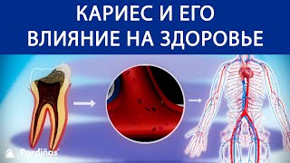 Кариес - что это такое, виды, симптомы