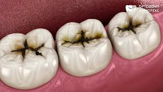 Кариес. Все, что вам нужно знать, чтобы защитить себя от кариеса